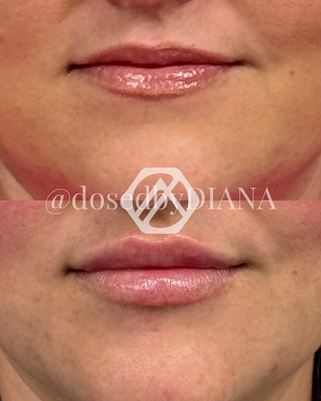 Lip filler