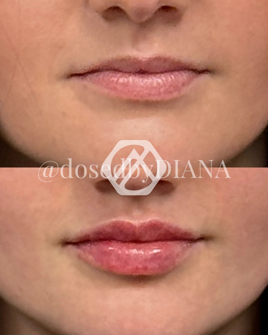Lip filler