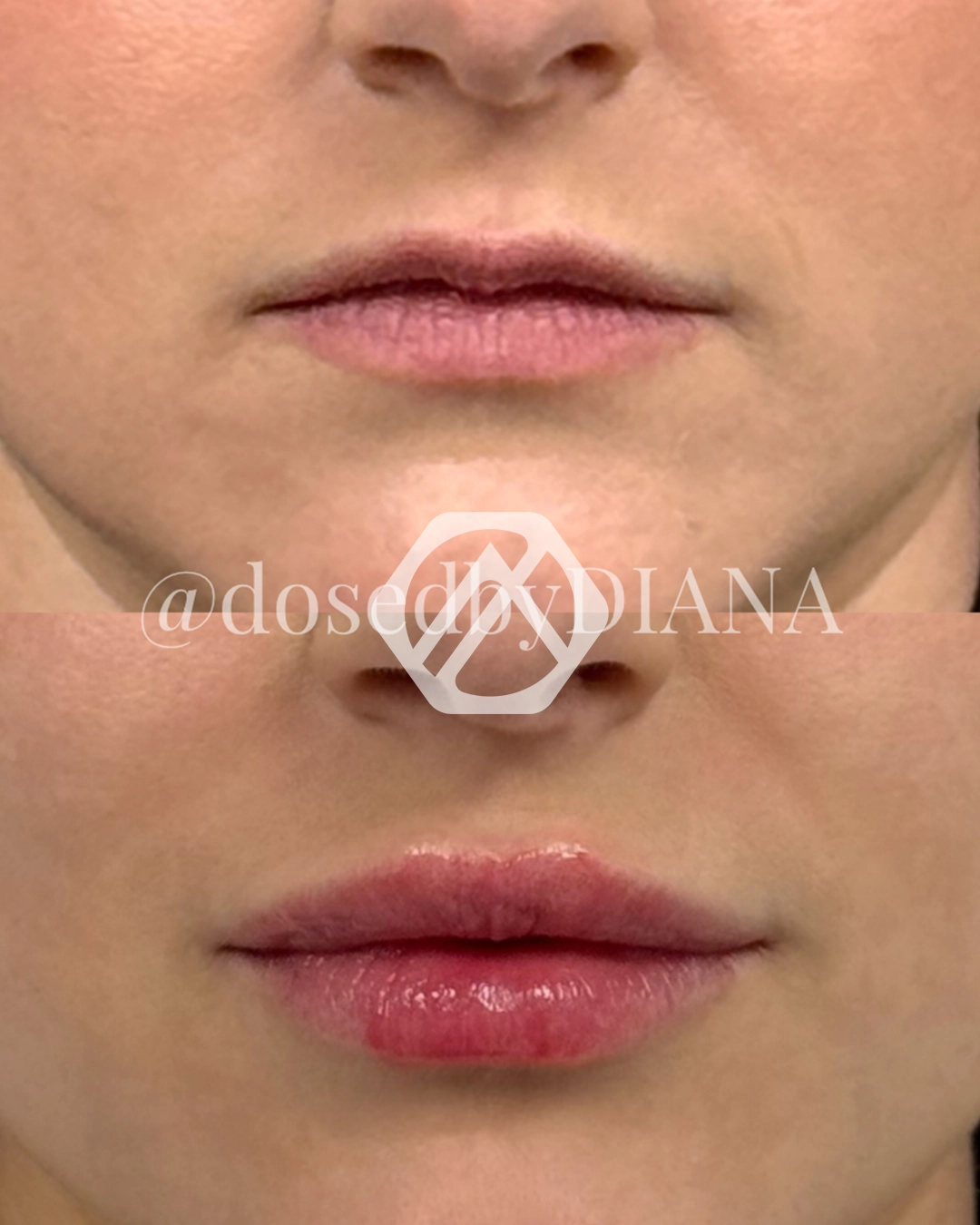 Lip filler