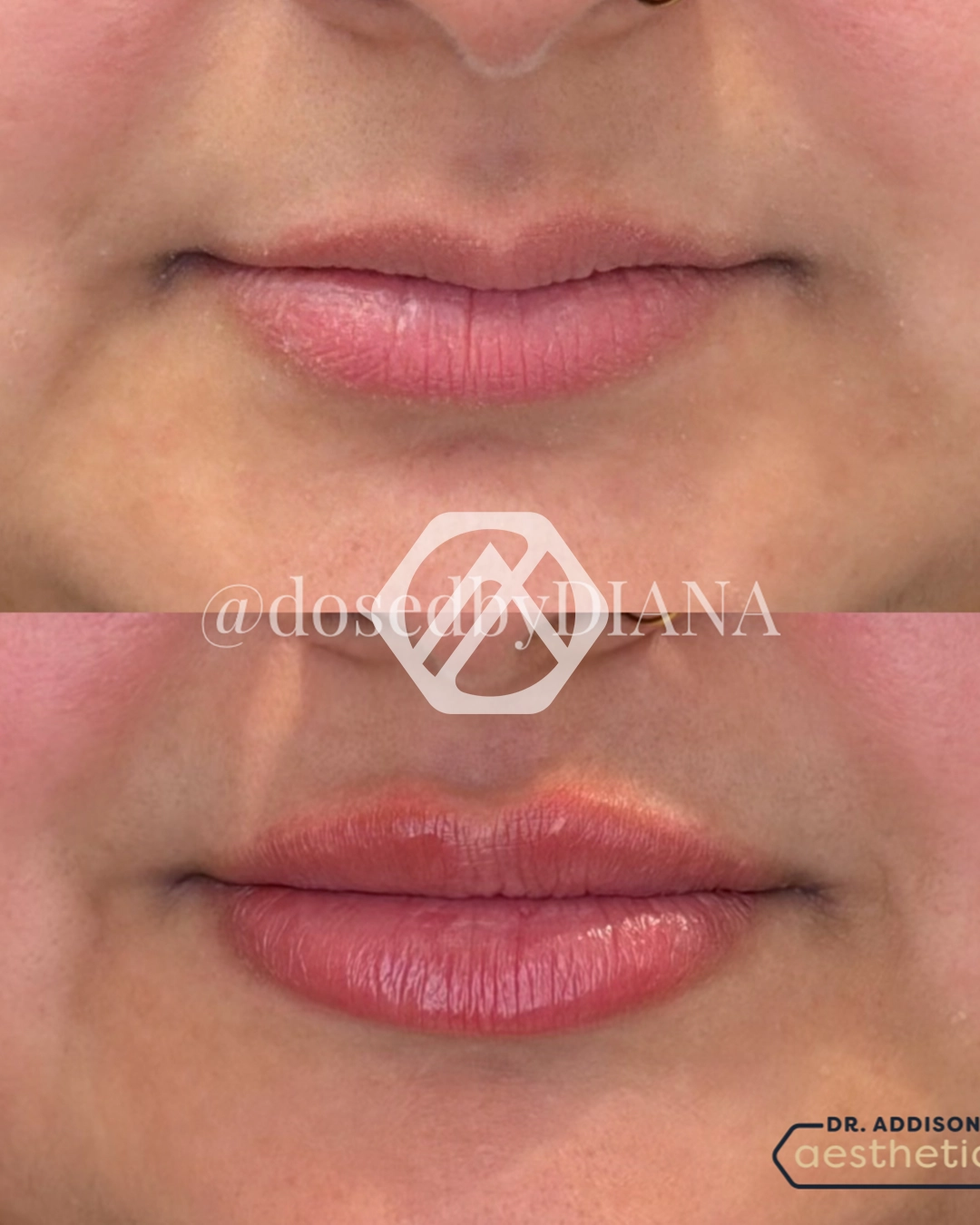 Lip filler