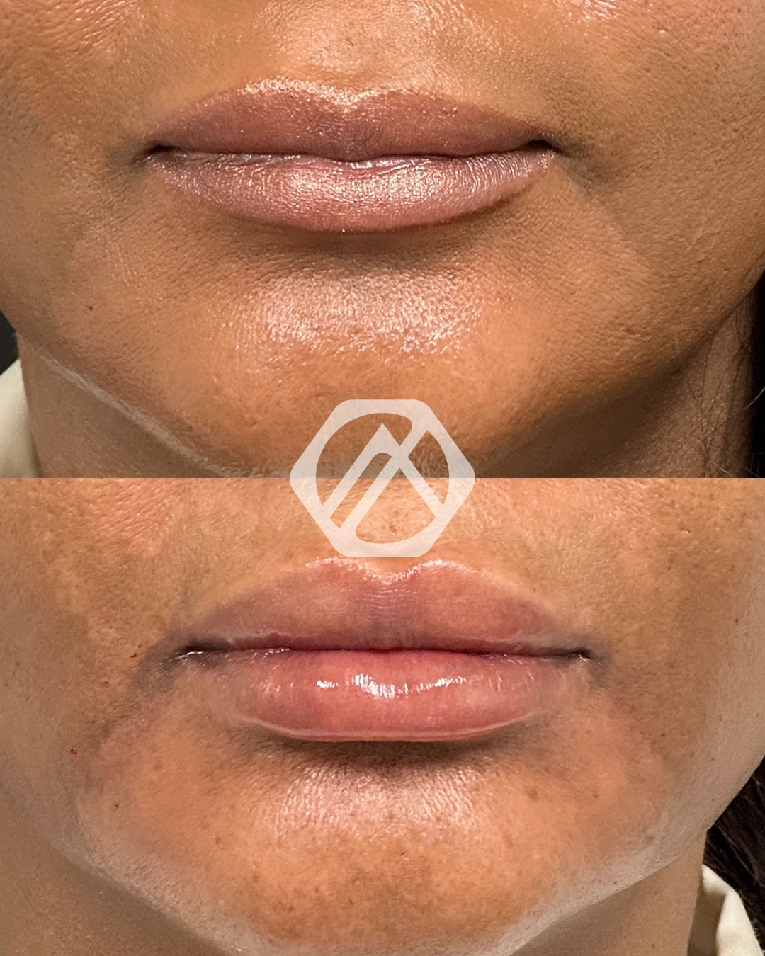 Lip filler