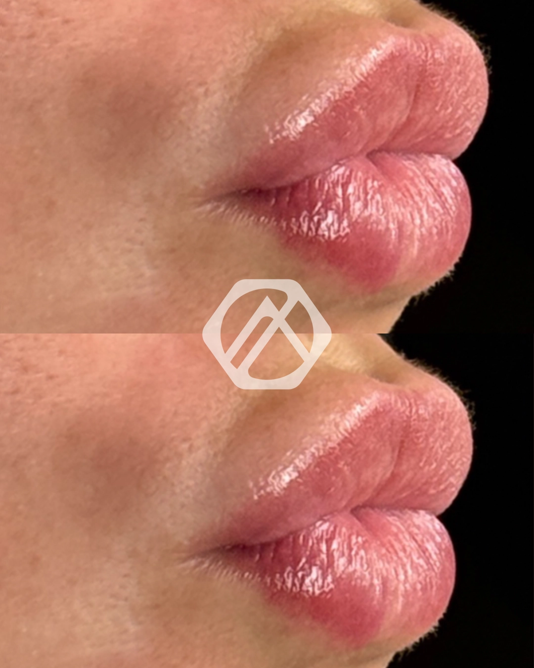 Lip filler