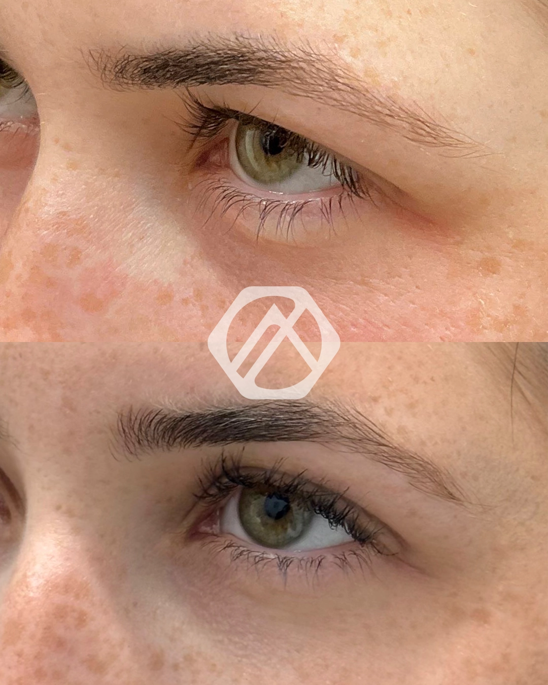 Undereye