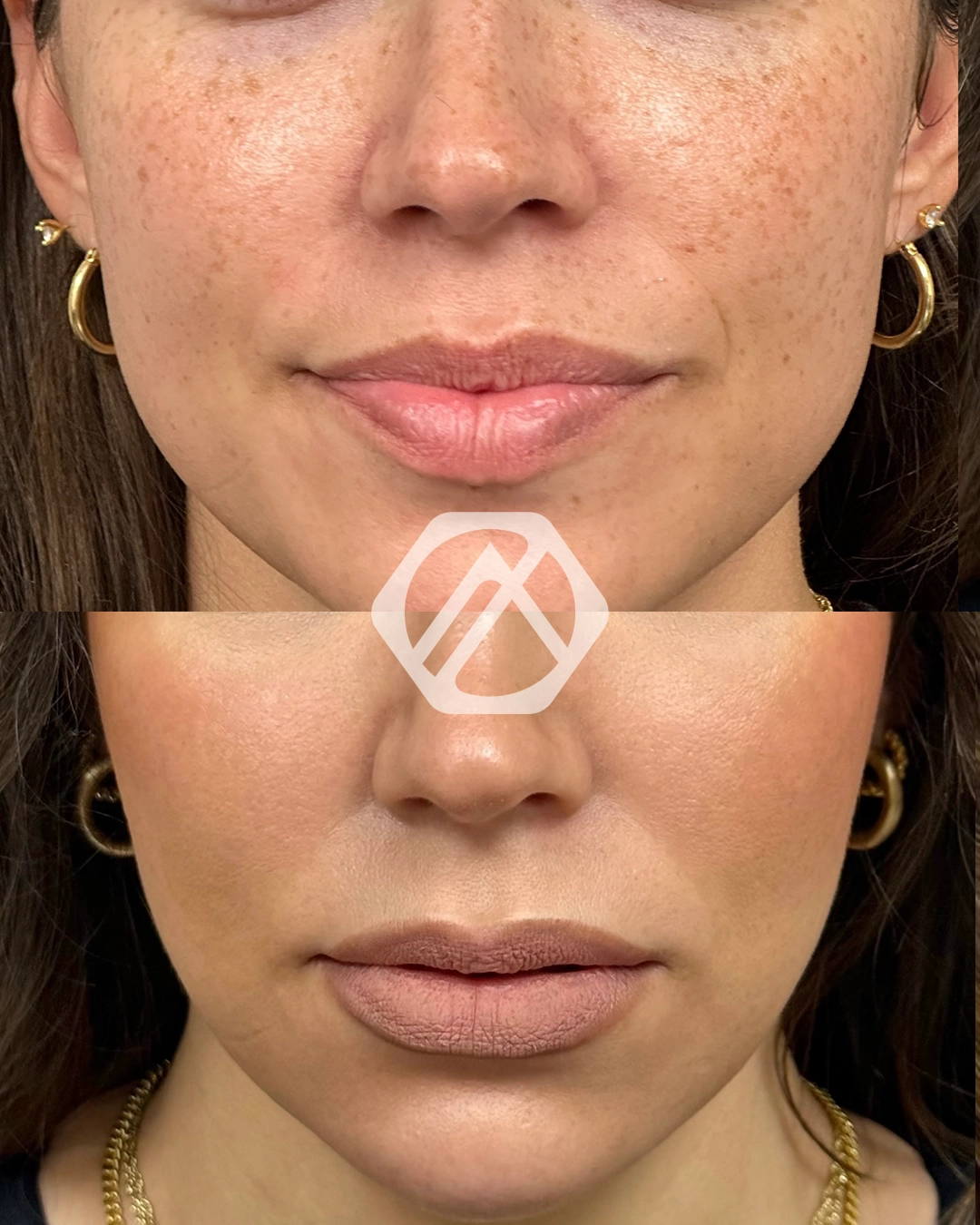 Facial Balancing