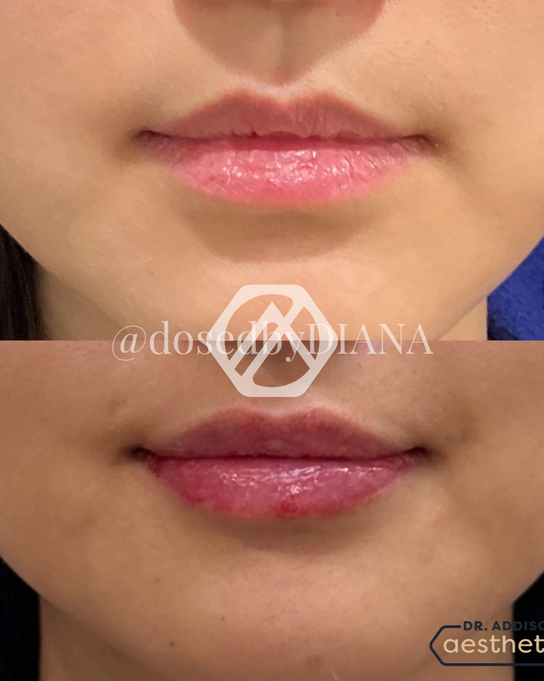 Lip filler