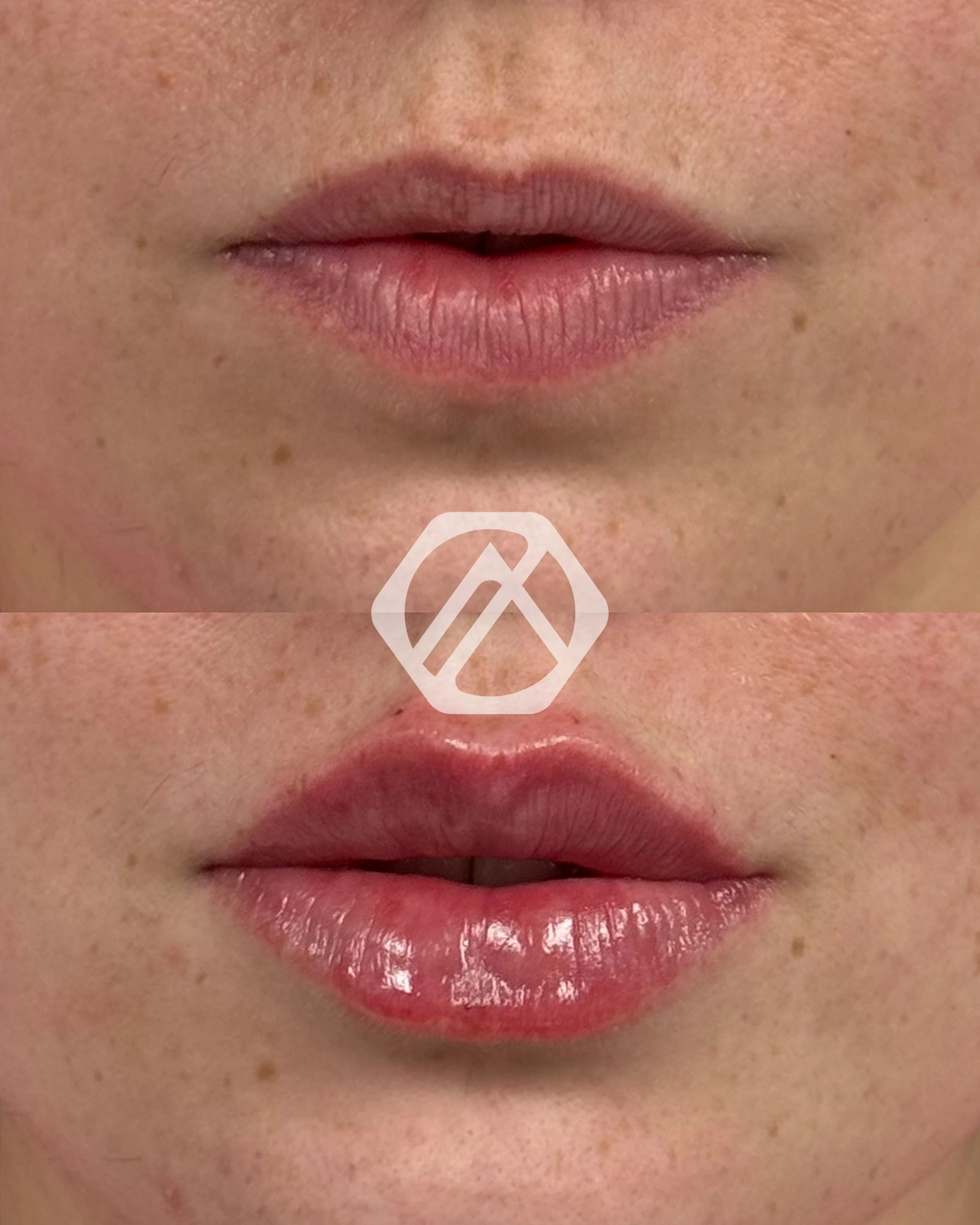 Lip filler