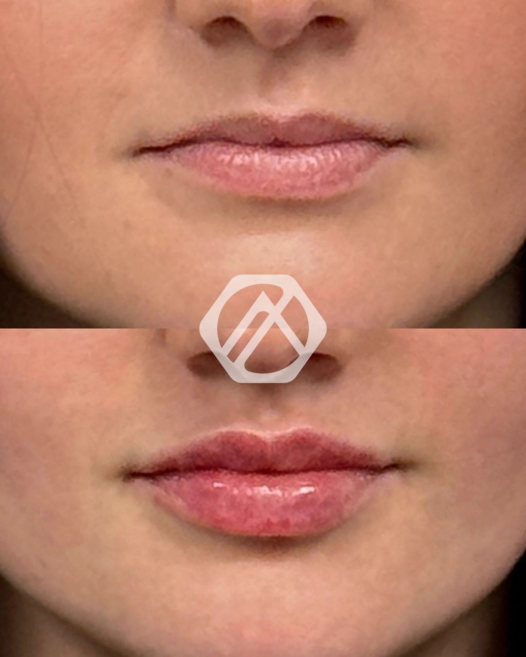 Lip filler