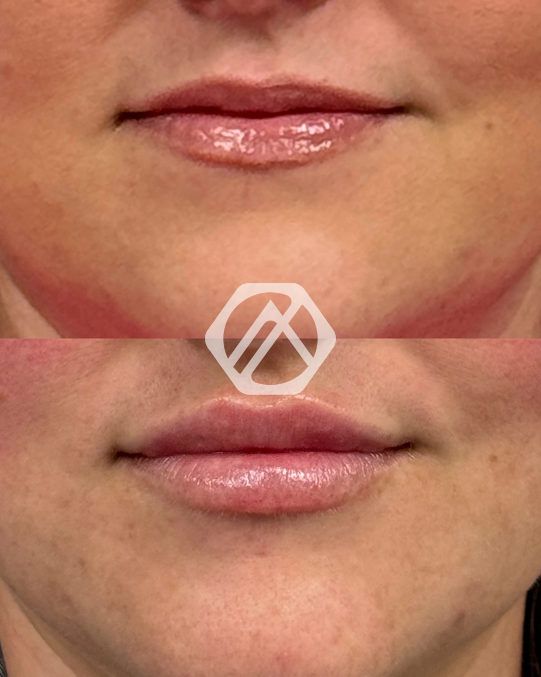 Lip filler