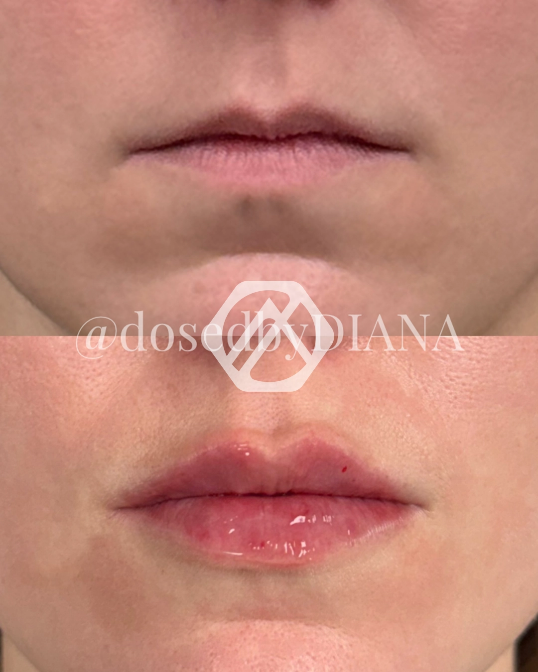 Lip filler