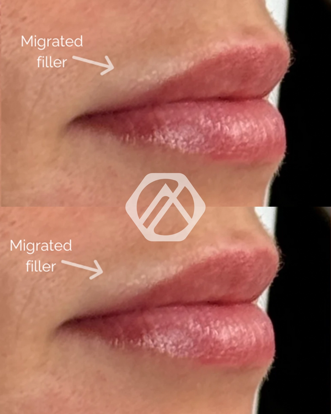 Lip filler