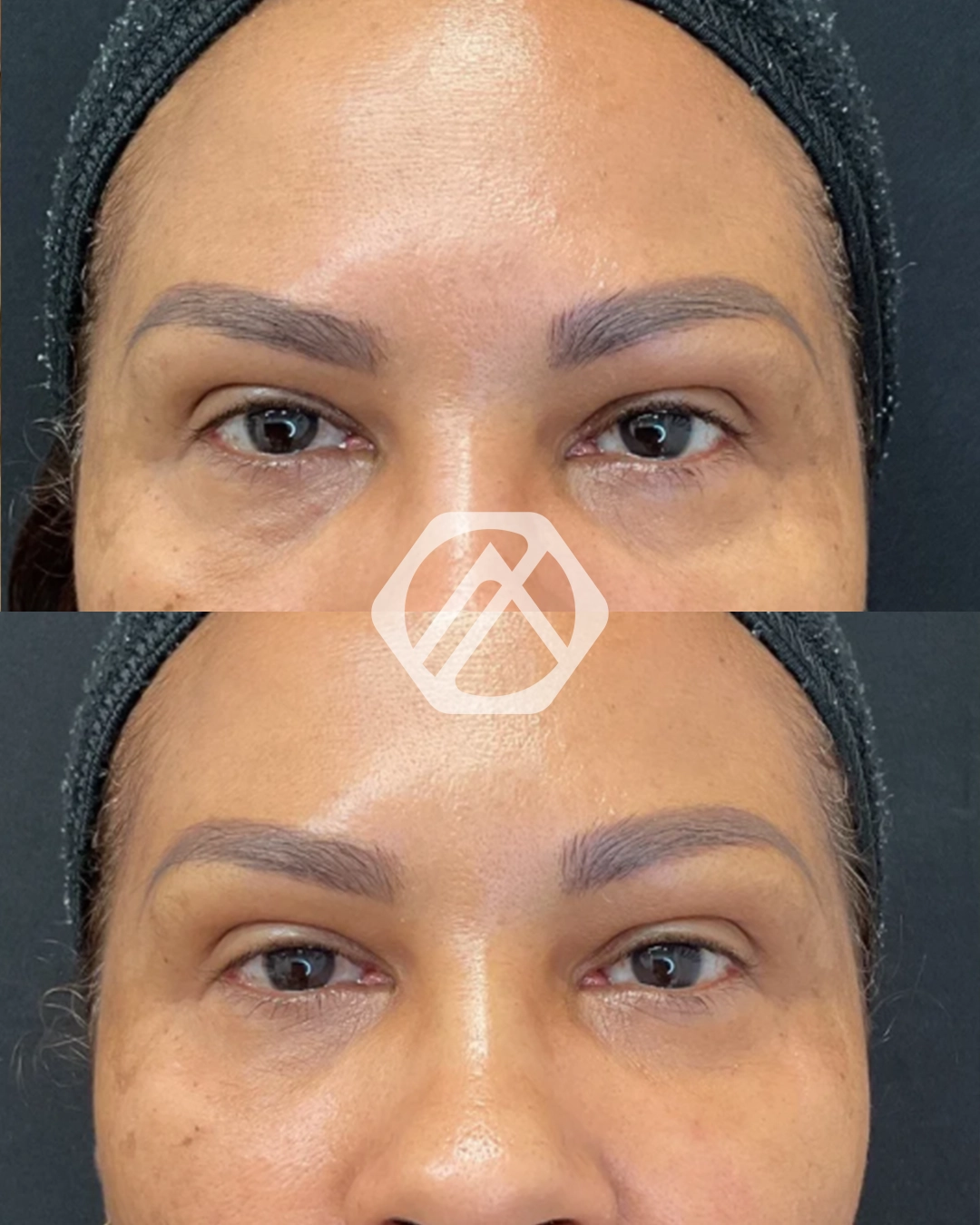 Undereye