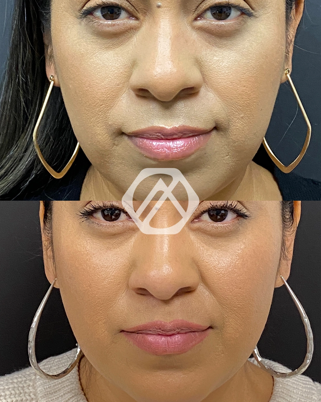 Facial Balancing
