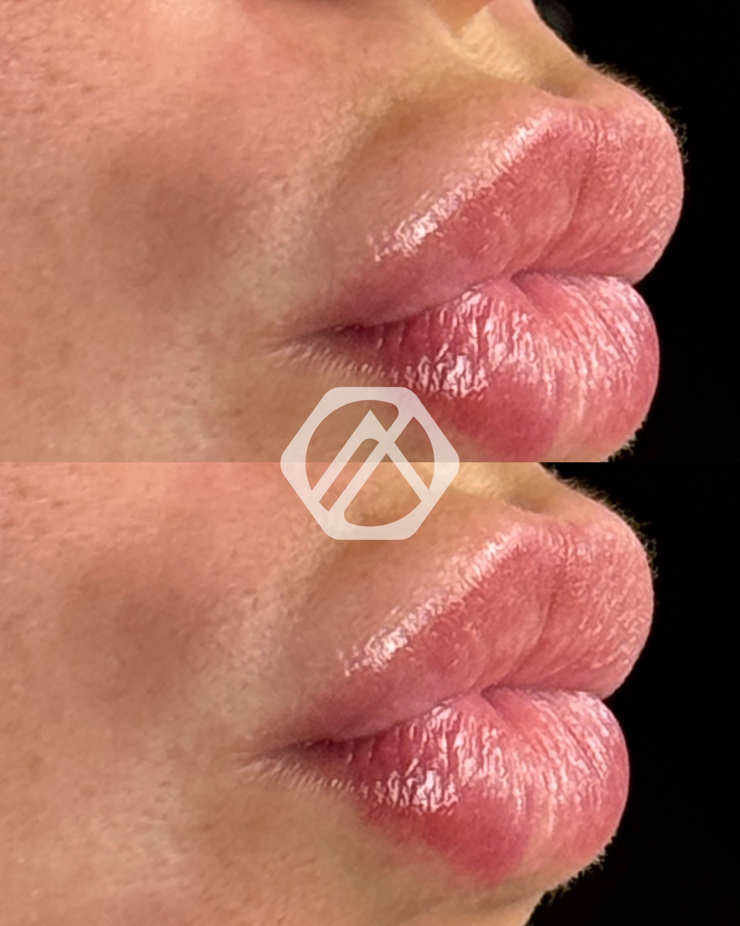 Lip filler