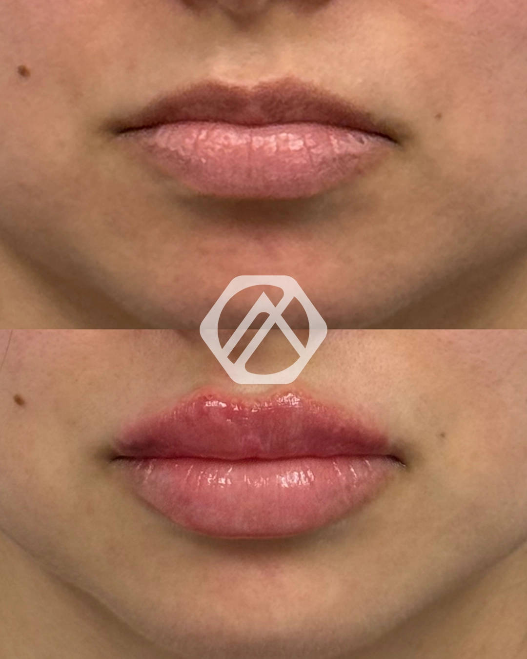 Lip filler