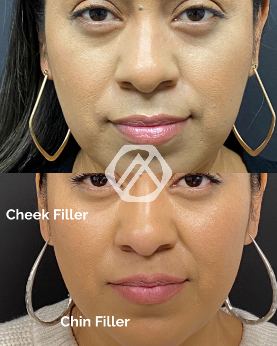 Facial Balancing