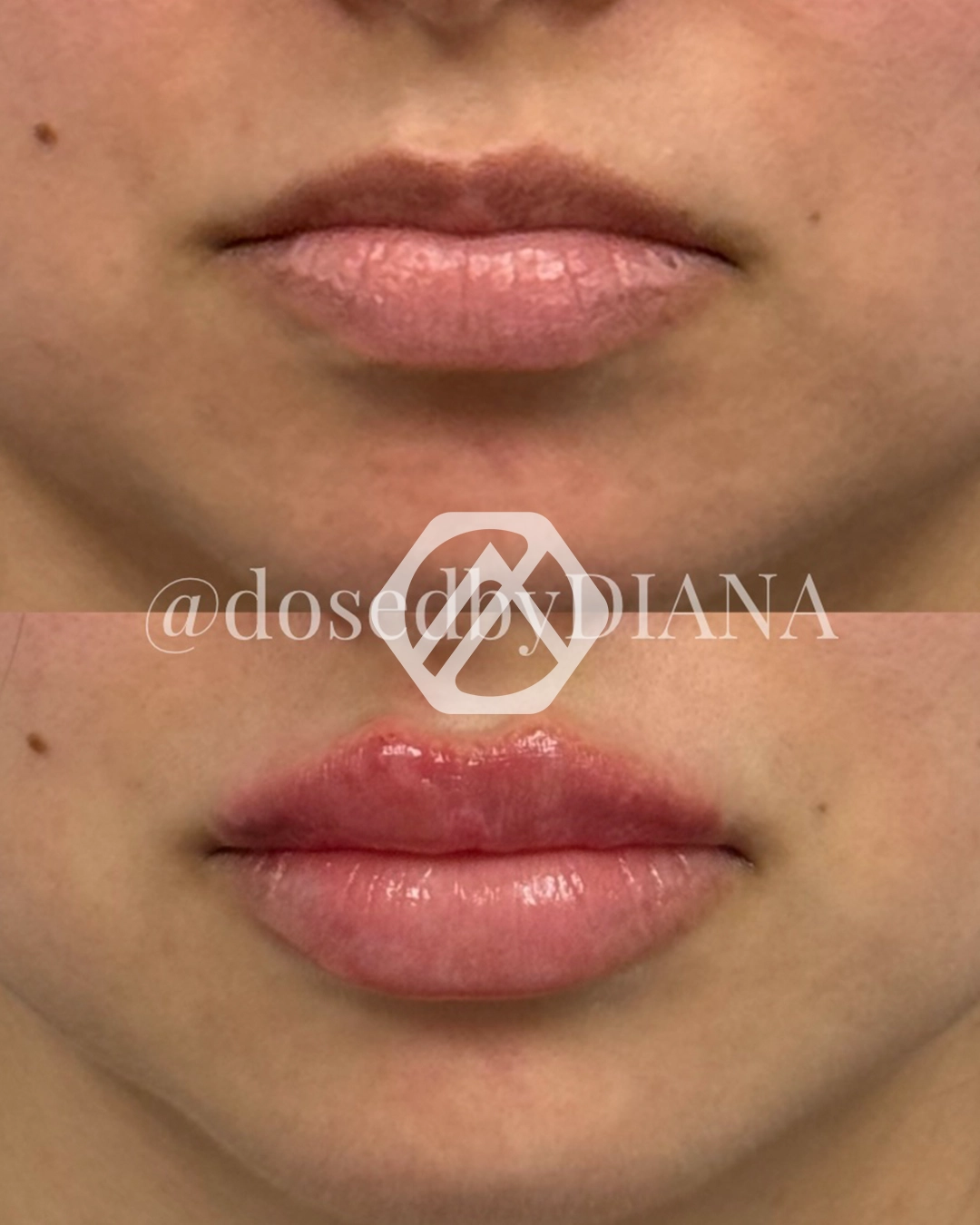 Lip filler