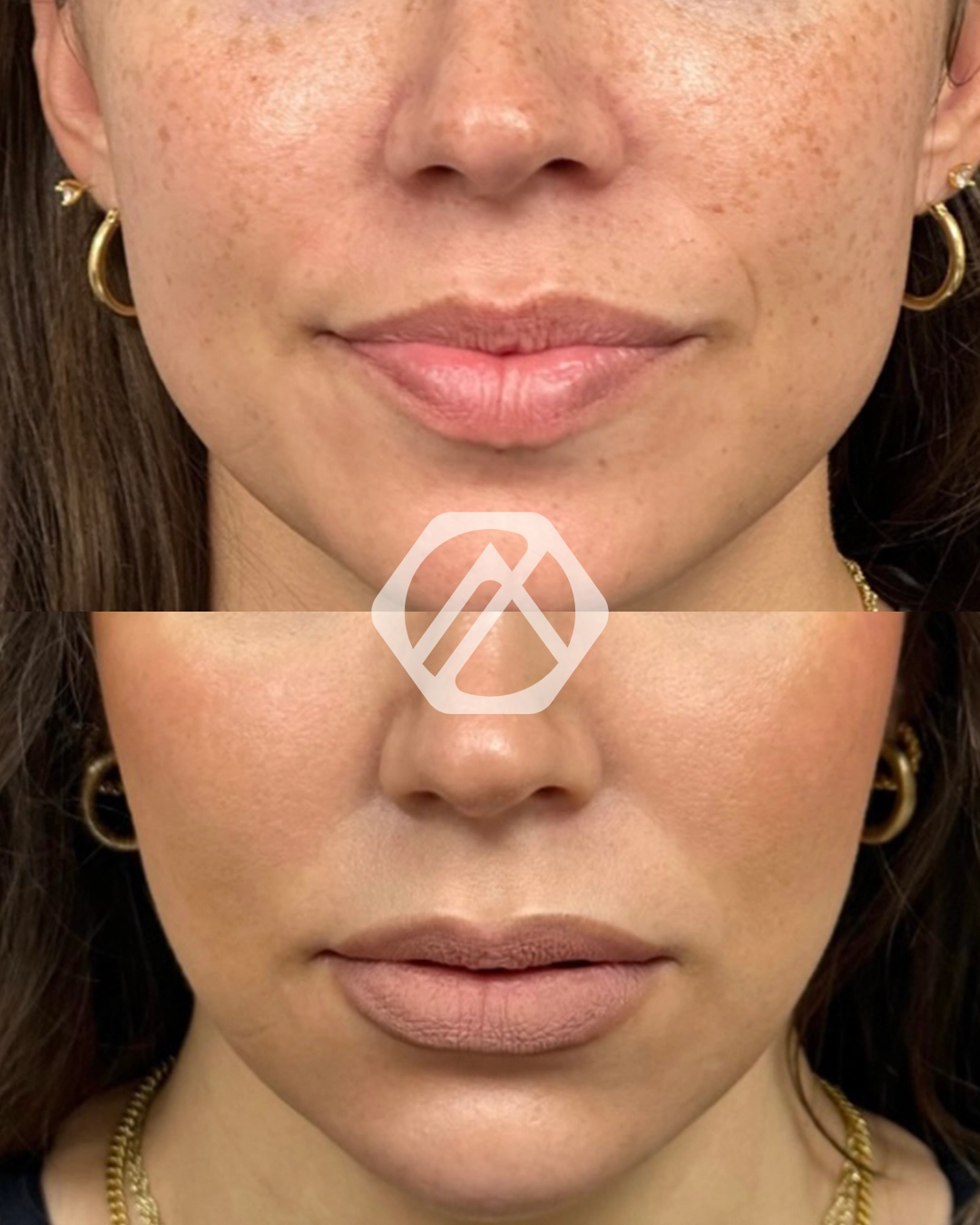 Facial Balancing