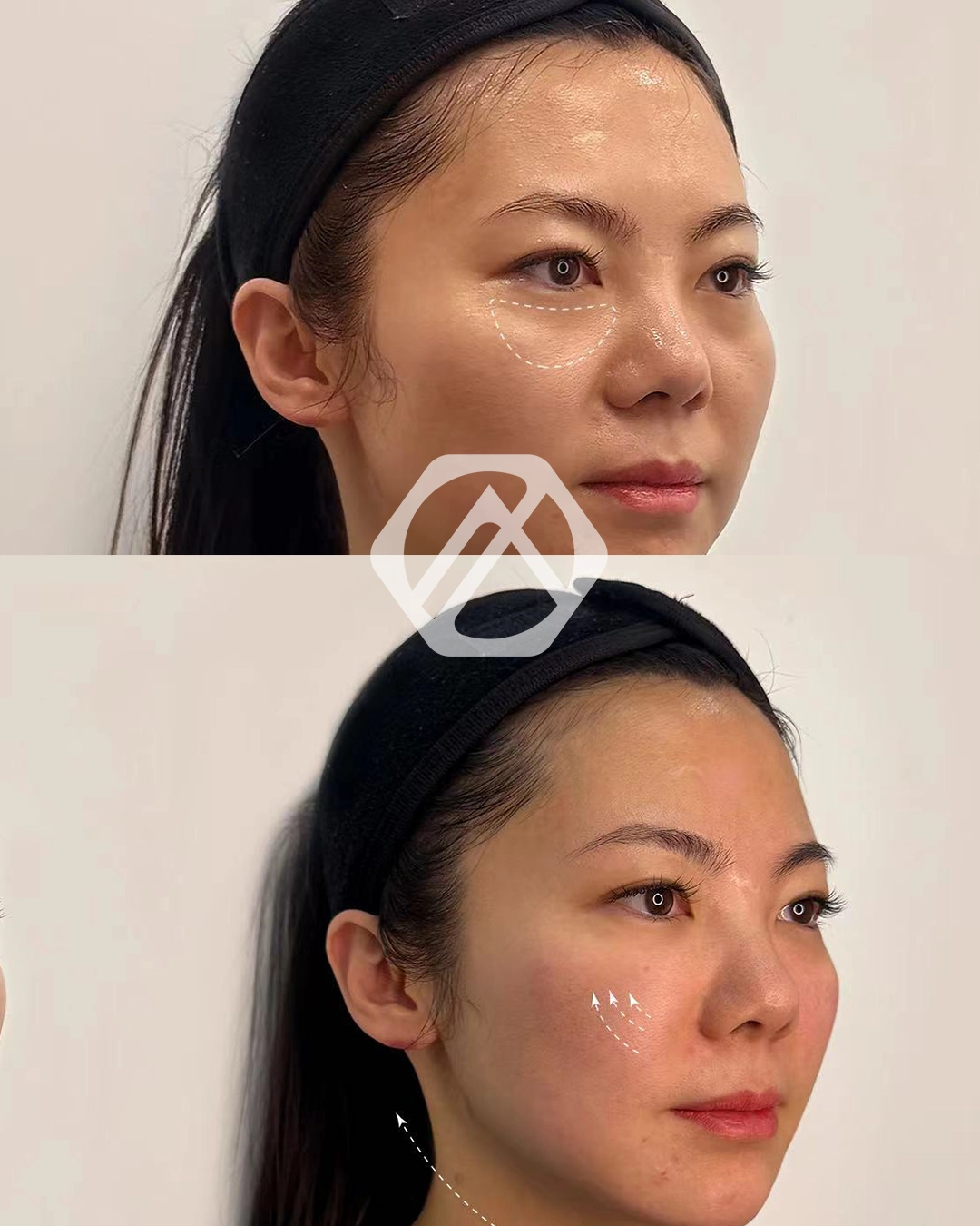 A patient's treatment before and after Botox