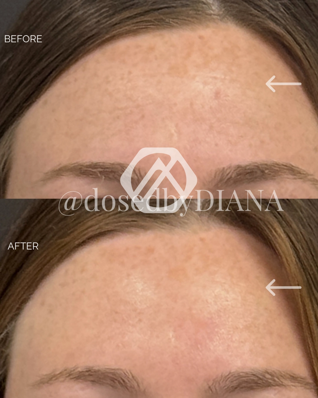 A patient's treatment before and after Botox
