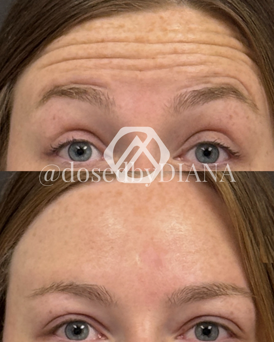 A patient's treatment before and after Botox