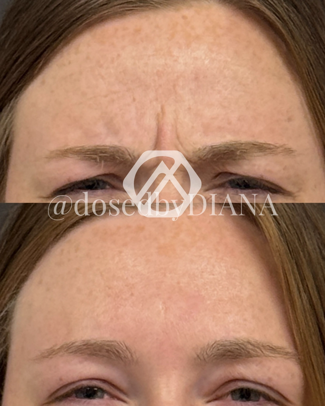 A patient's treatment before and after Botox