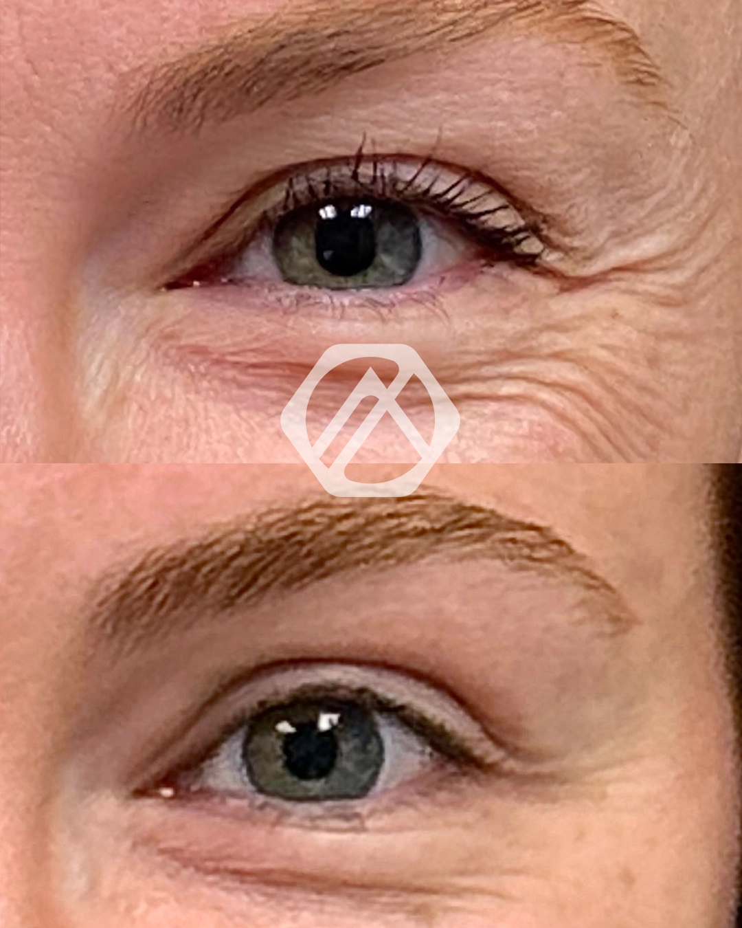 A patient's treatment before and after Botox