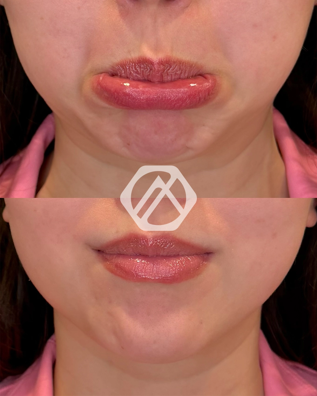A patient's treatment before and after Botox
