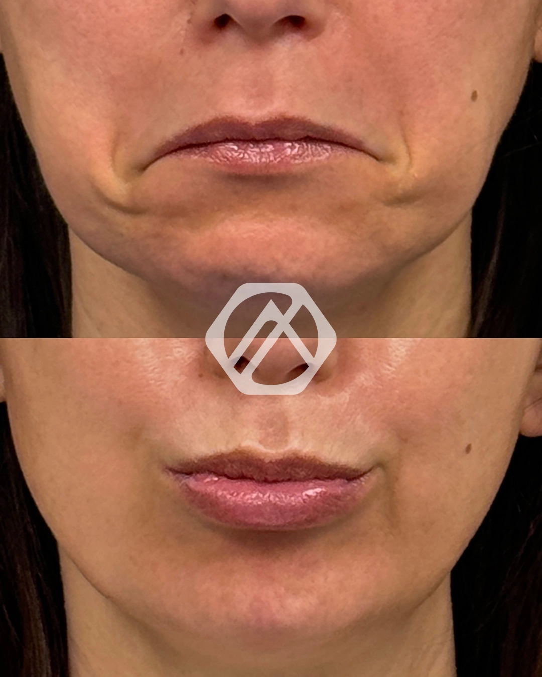 A patient's treatment before and after Botox