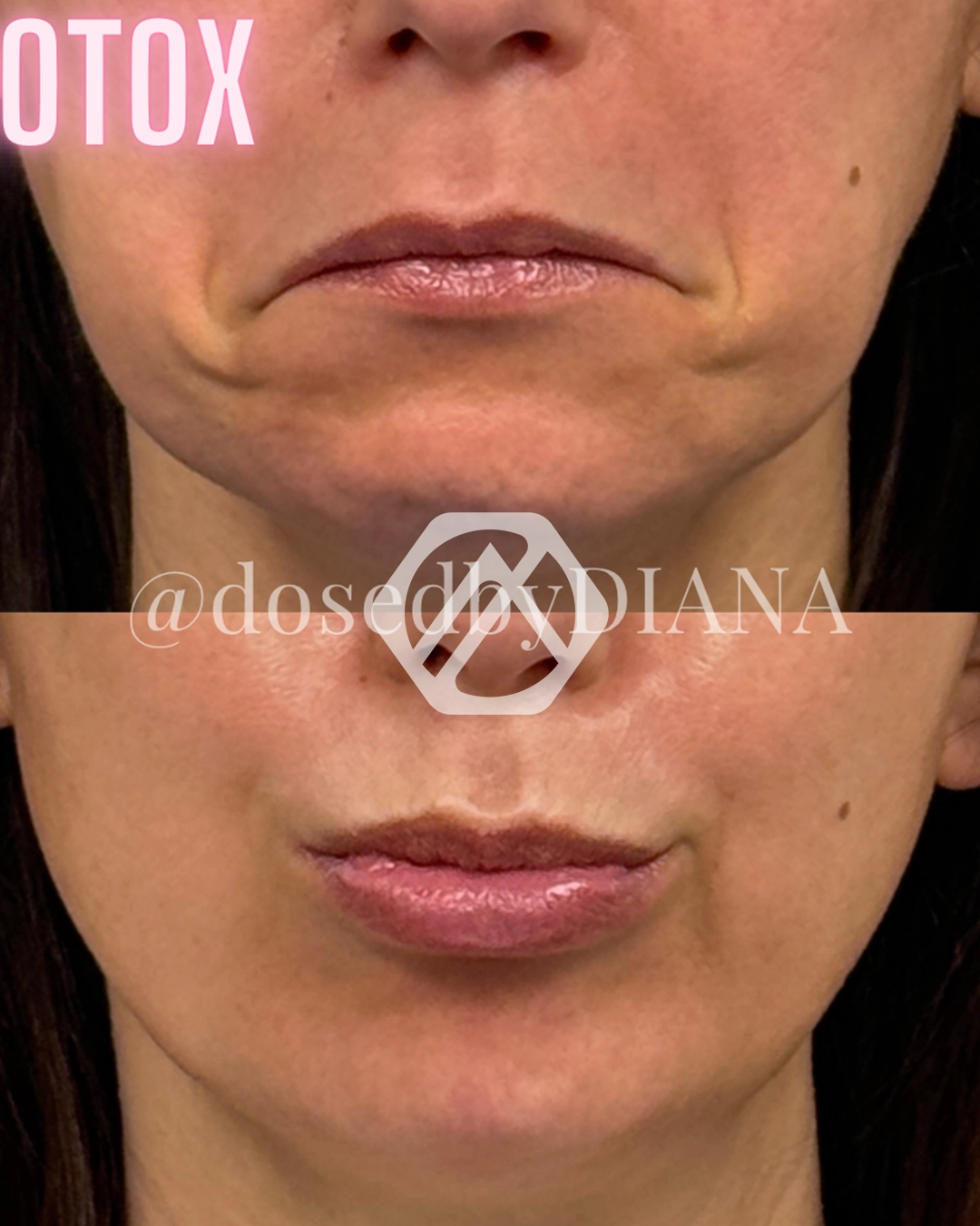 A patient's treatment before and after Botox
