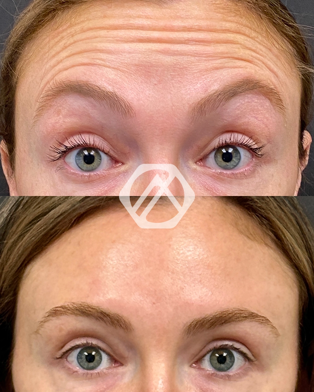 A patient's treatment before and after Botox