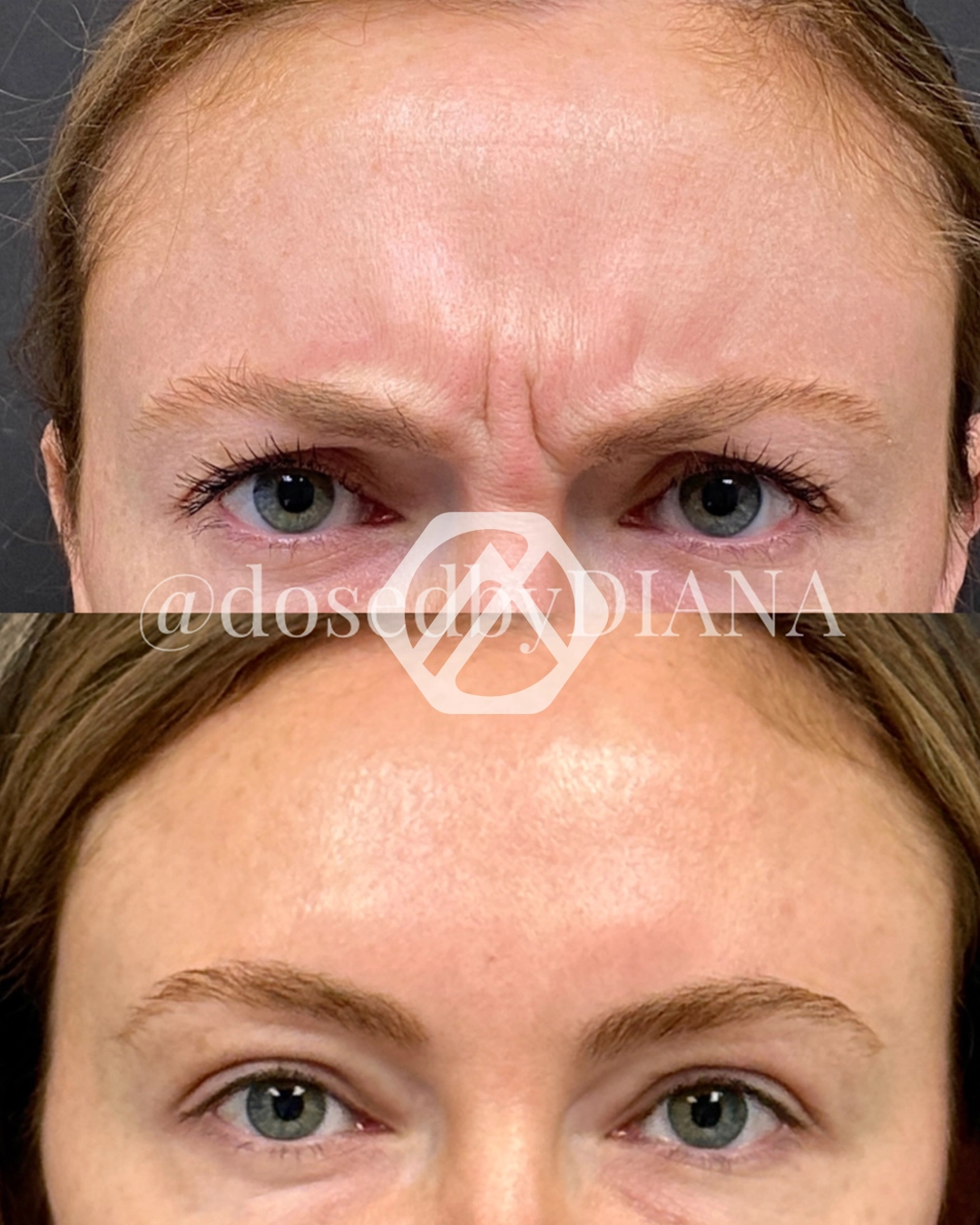 A patient's treatment before and after Botox