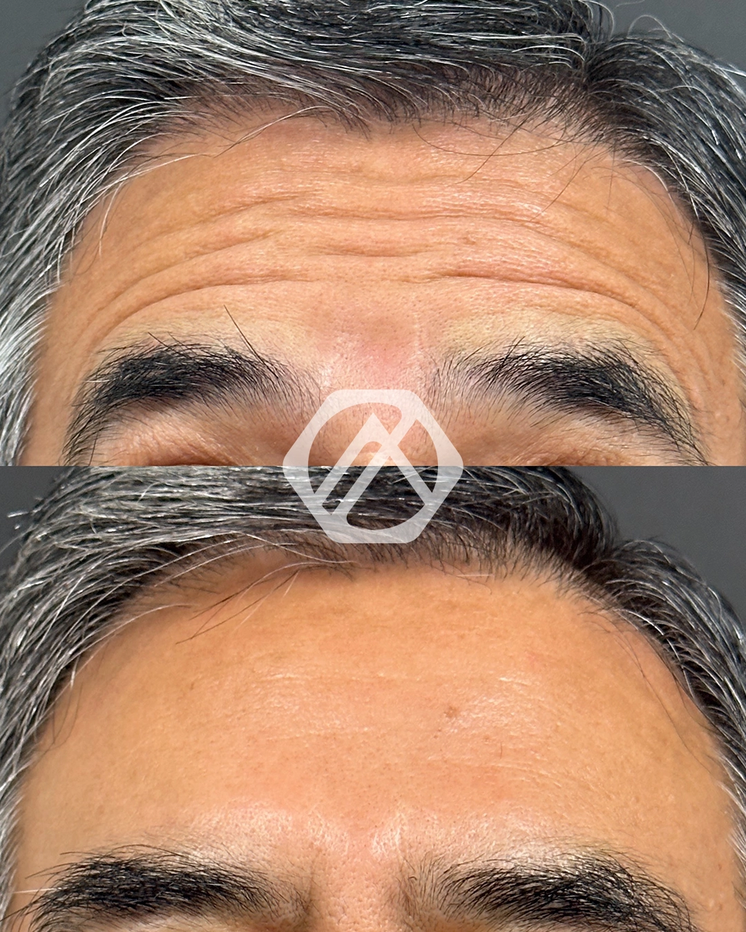 A patient's treatment before and after Botox