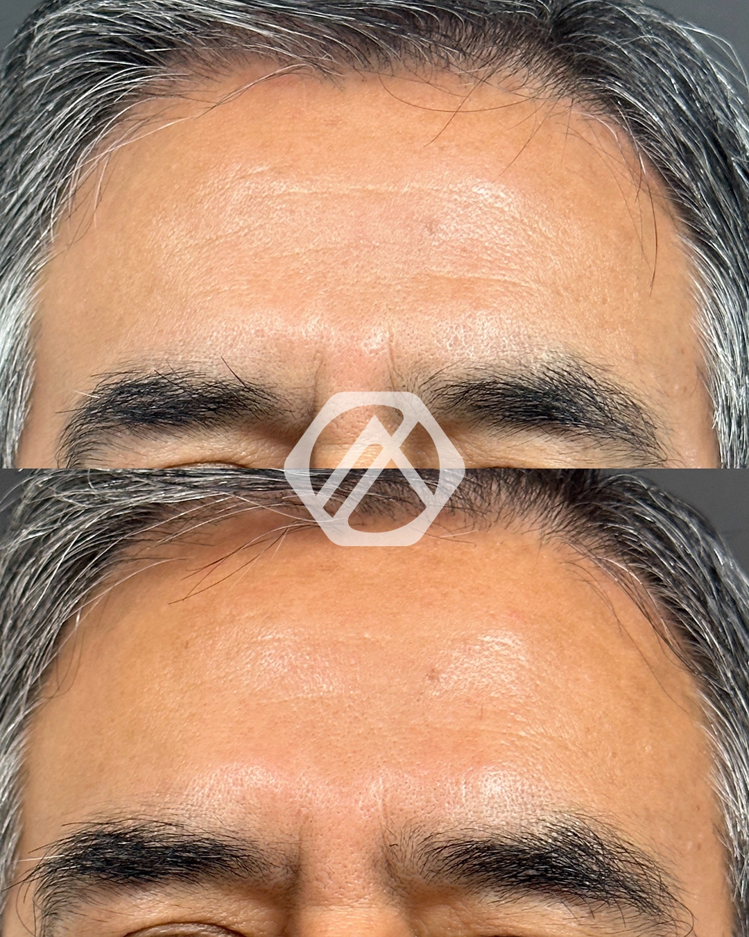 A patient's treatment before and after Botox