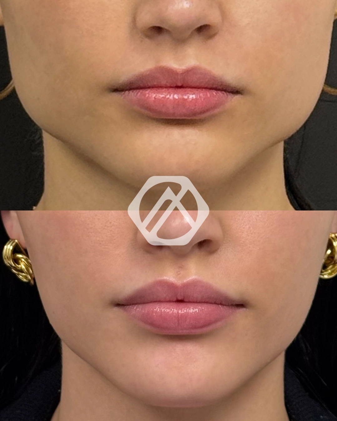A patient's treatment before and after Botox