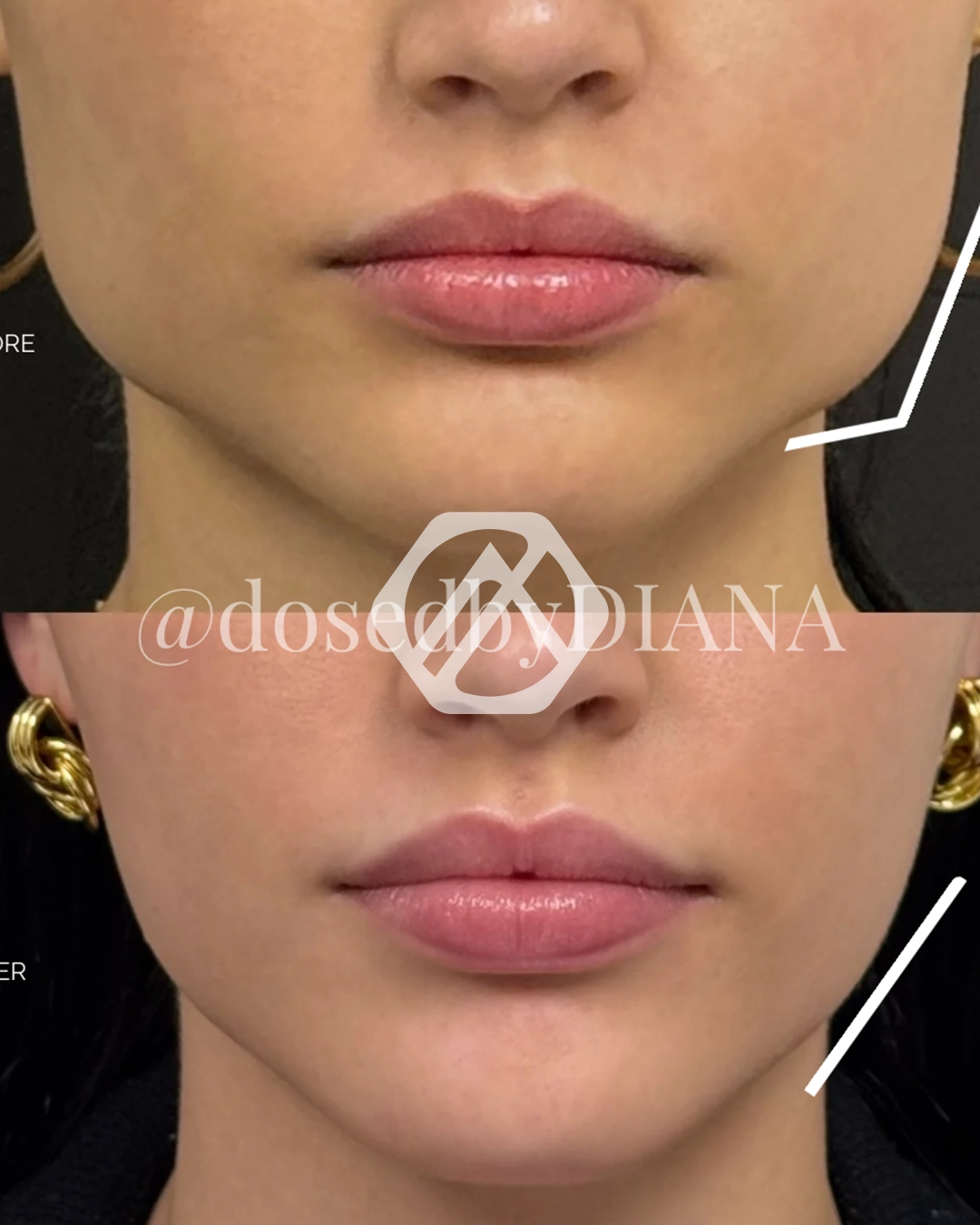 A patient's treatment before and after Botox
