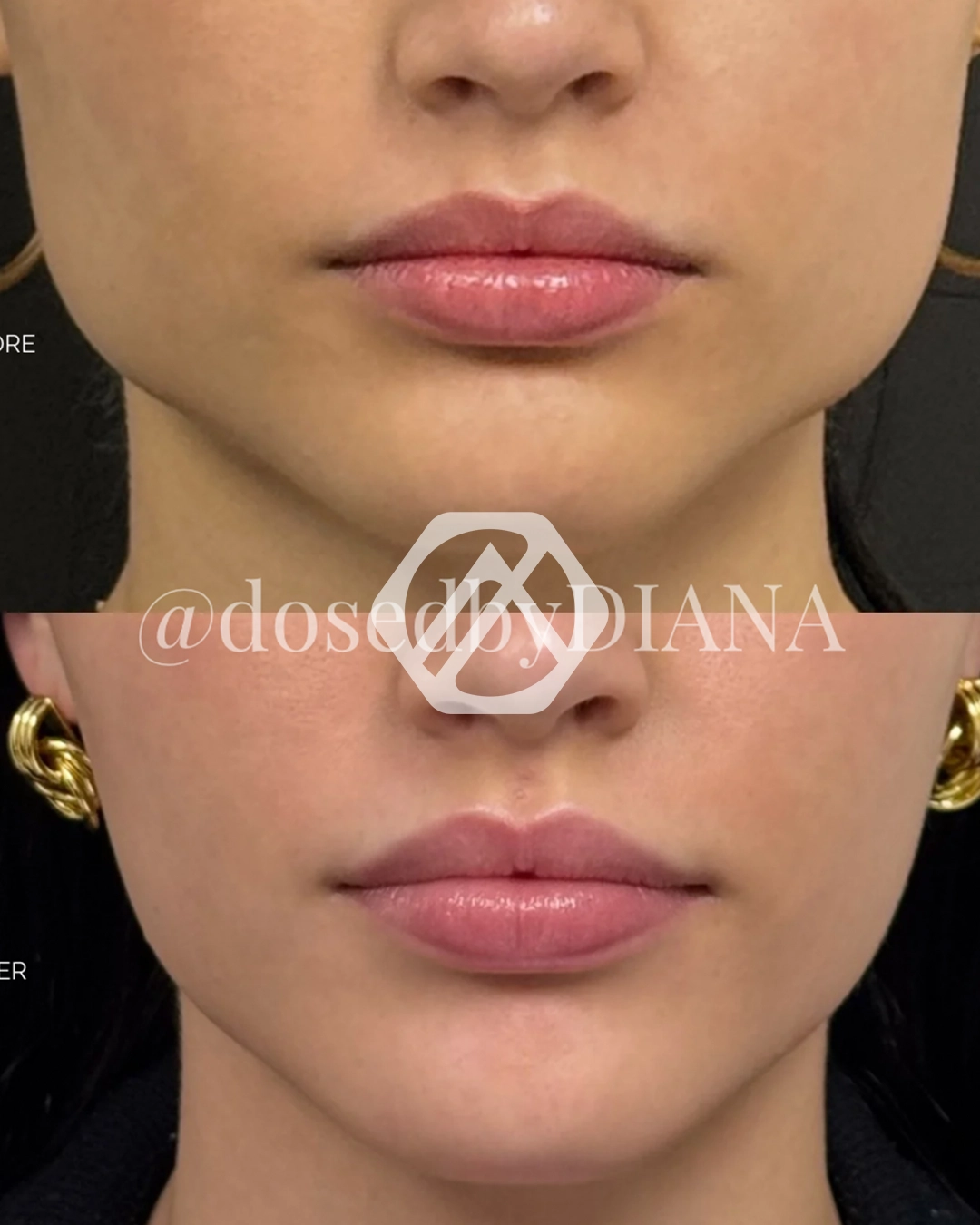 A patient's treatment before and after Botox