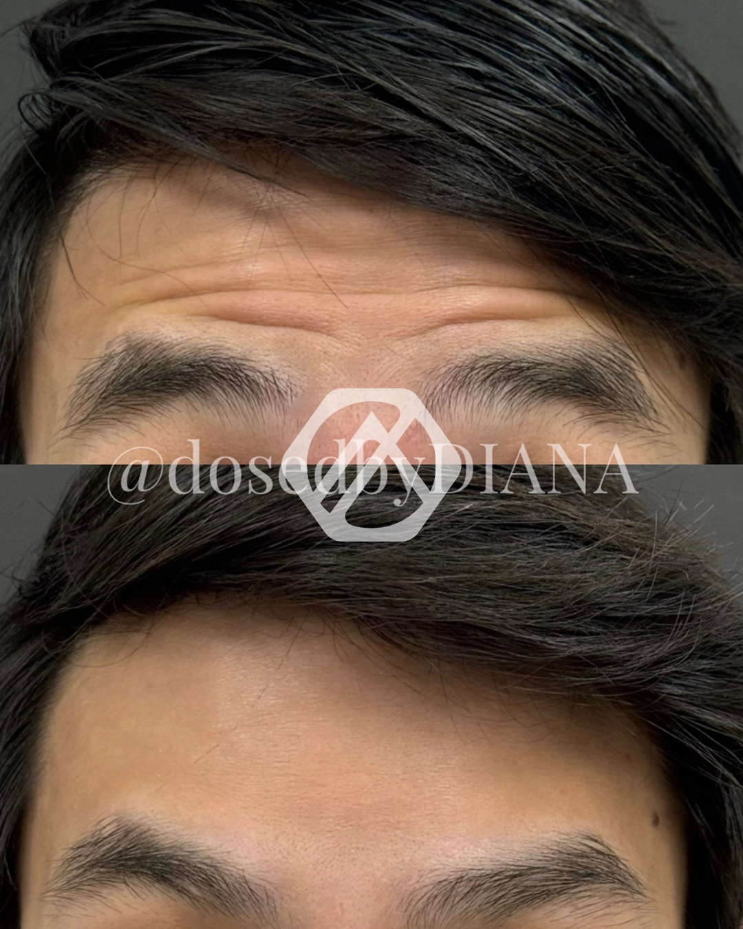 A patient's treatment before and after Botox