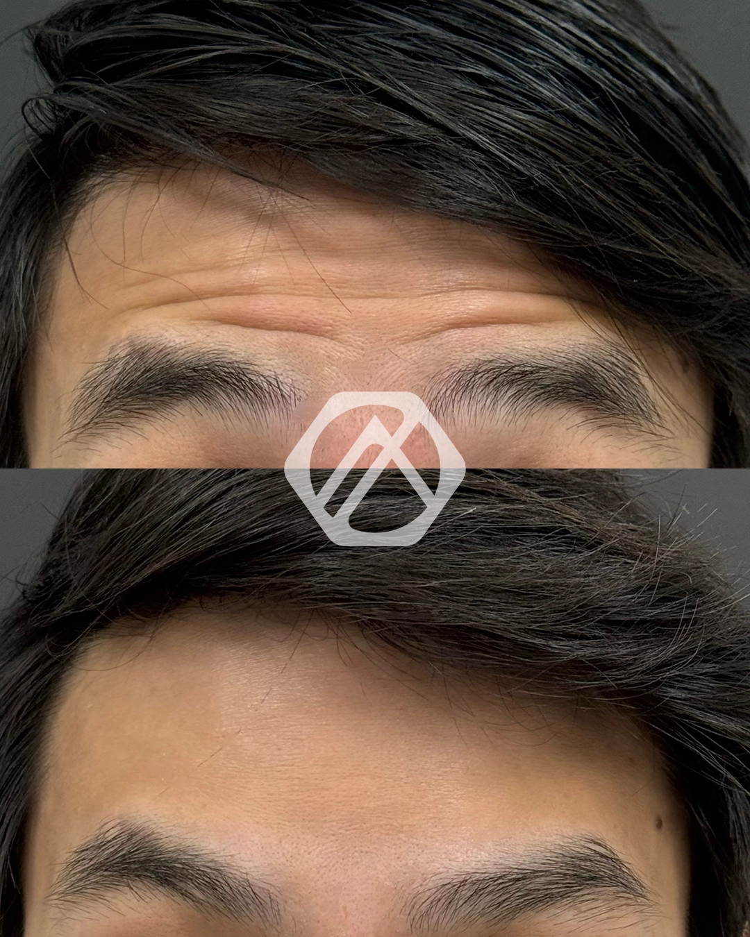 A patient's treatment before and after Botox