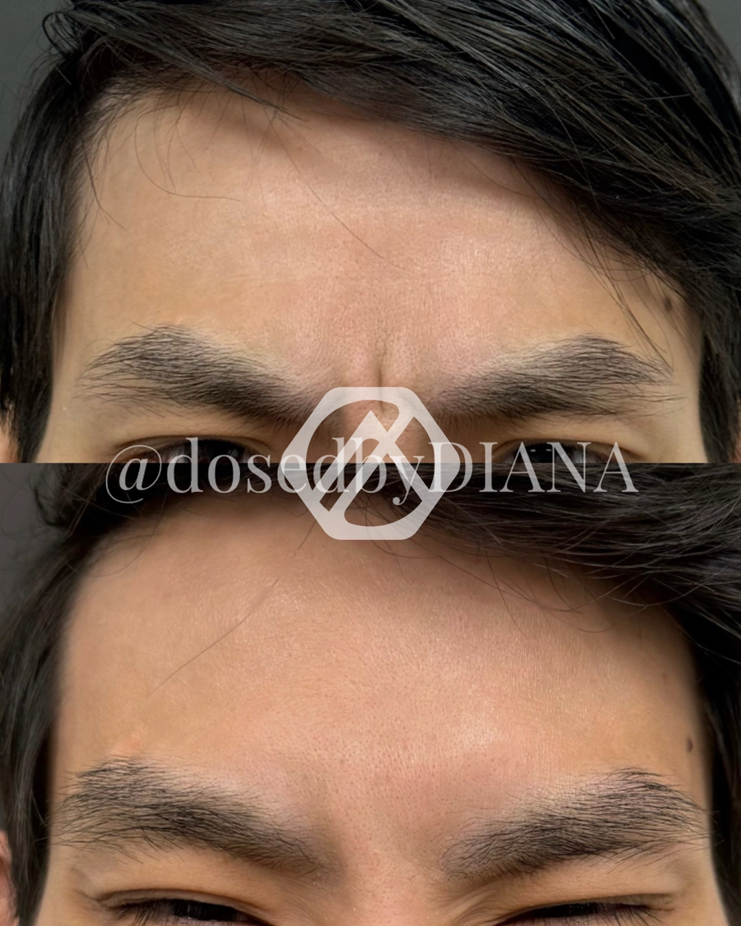 A patient's treatment before and after Botox