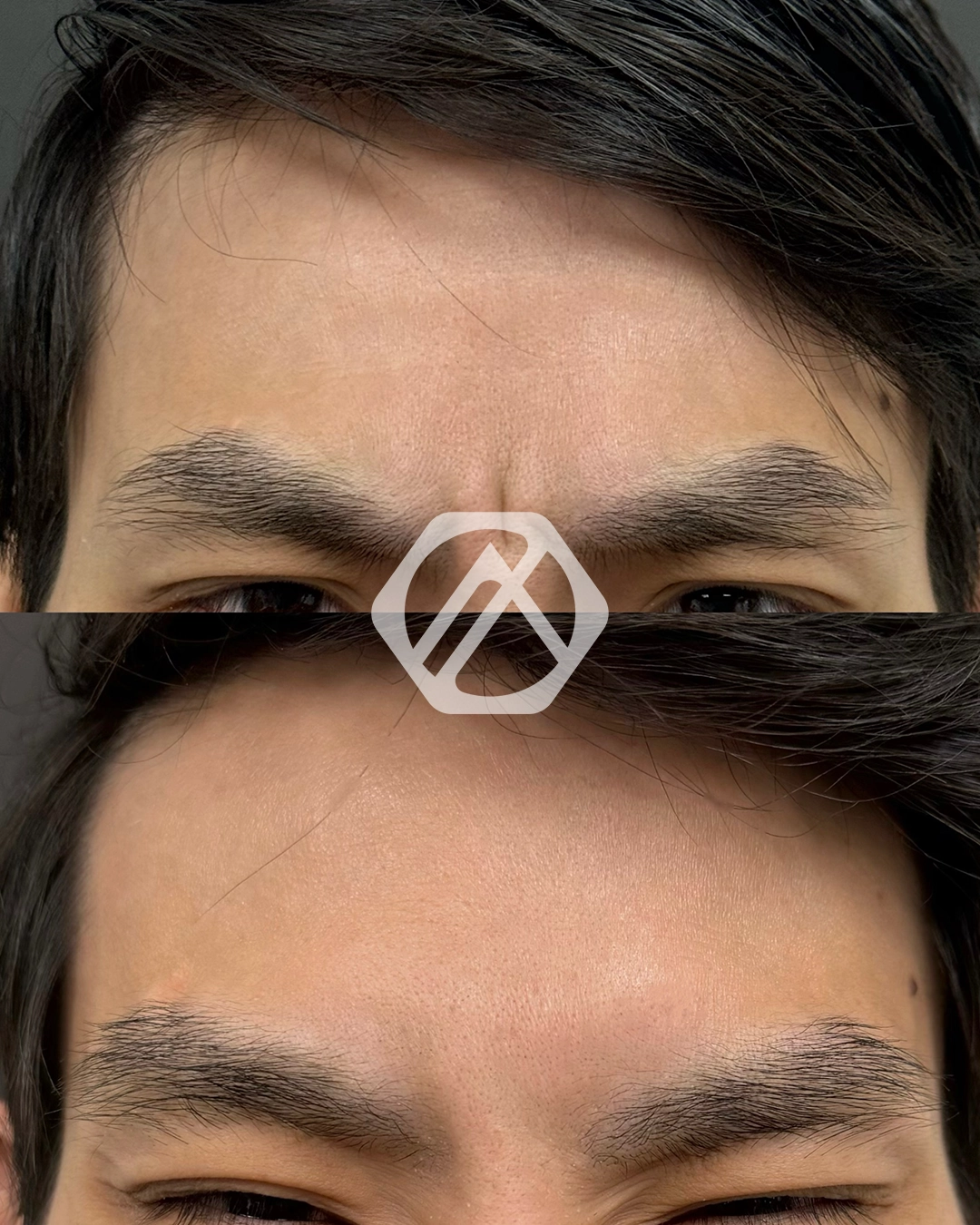 A patient's treatment before and after Botox