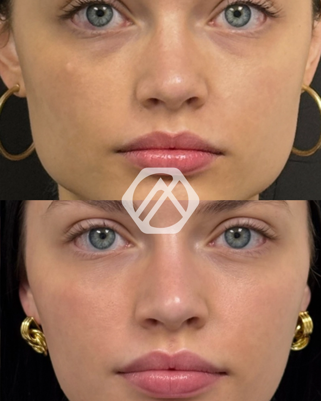 A patient's treatment before and after Botox