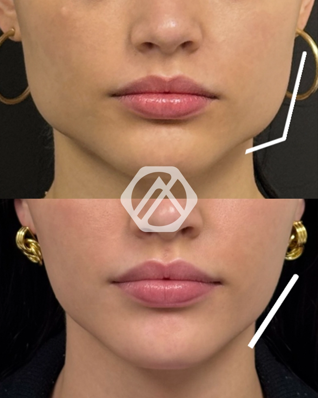 A patient's treatment before and after Botox