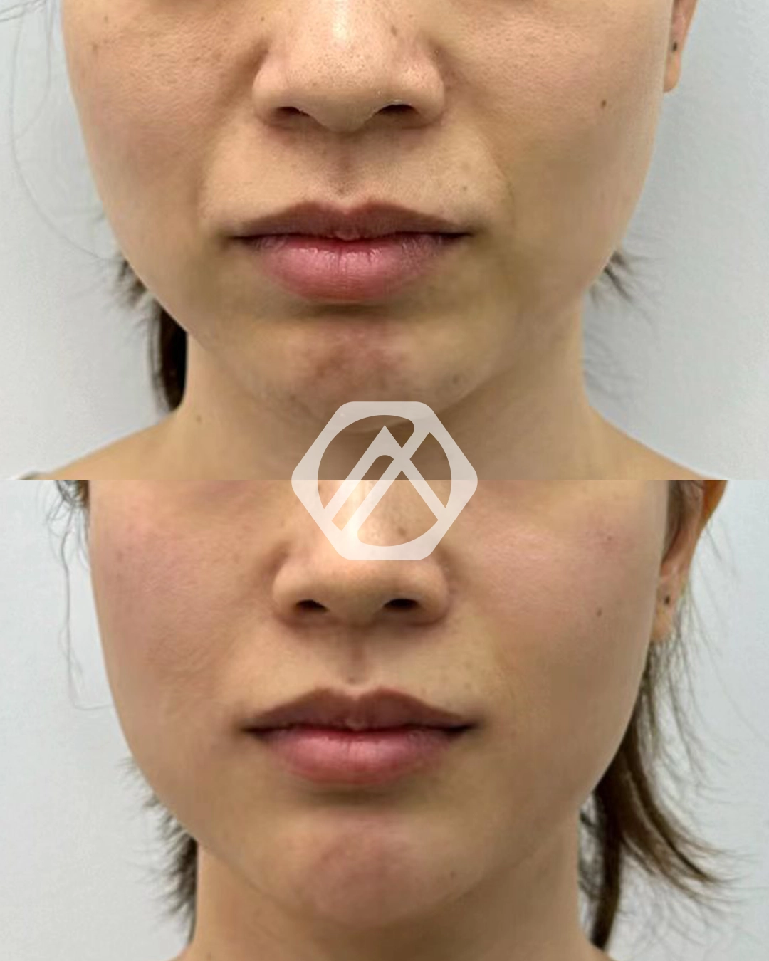 A patient before and after Chin Filler