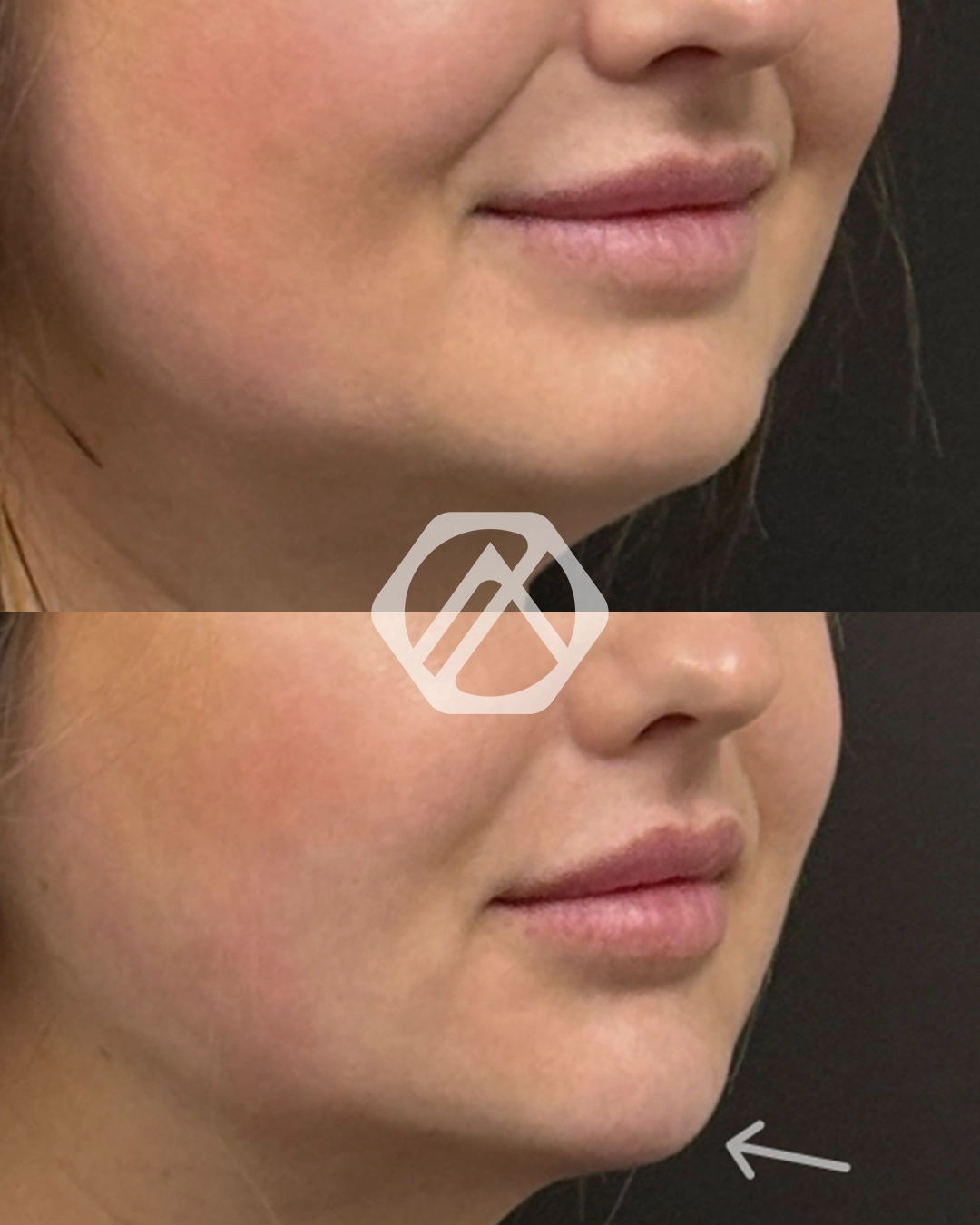 A patient before and after Chin Filler