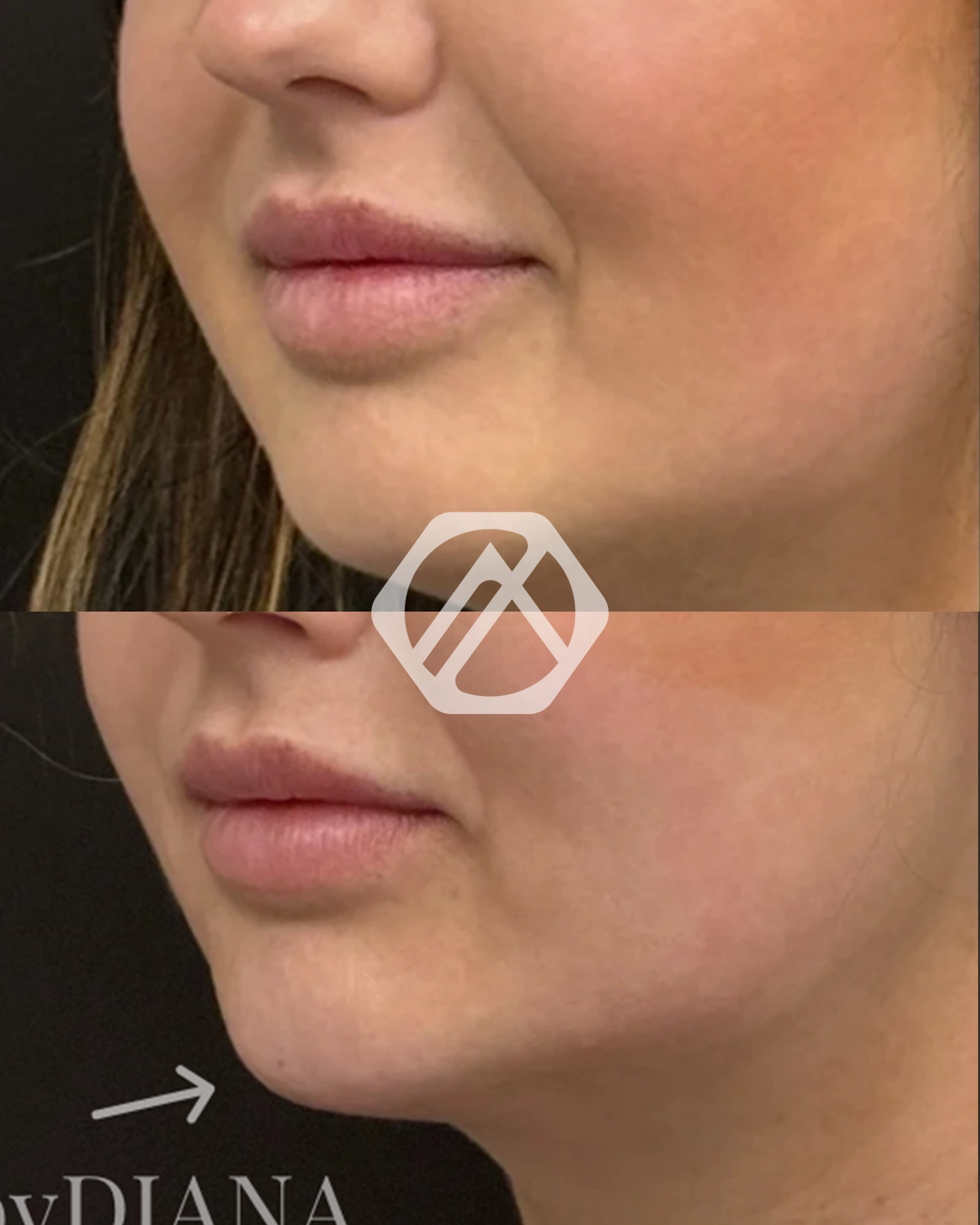 A patient before and after Chin Filler