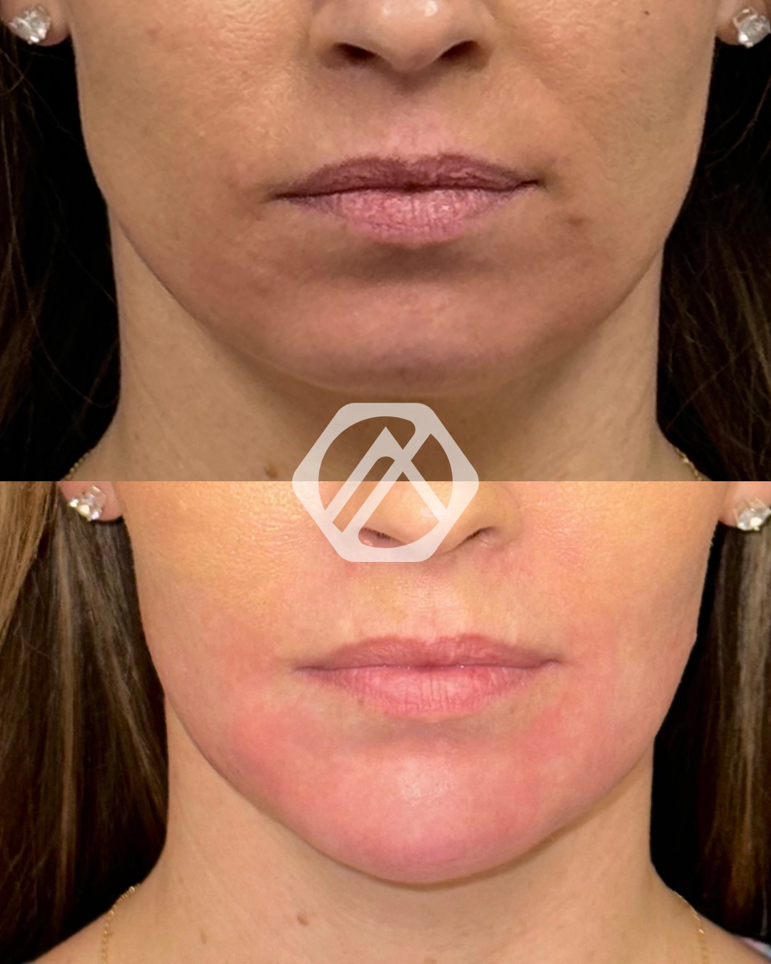 A patient before and after Chin Filler