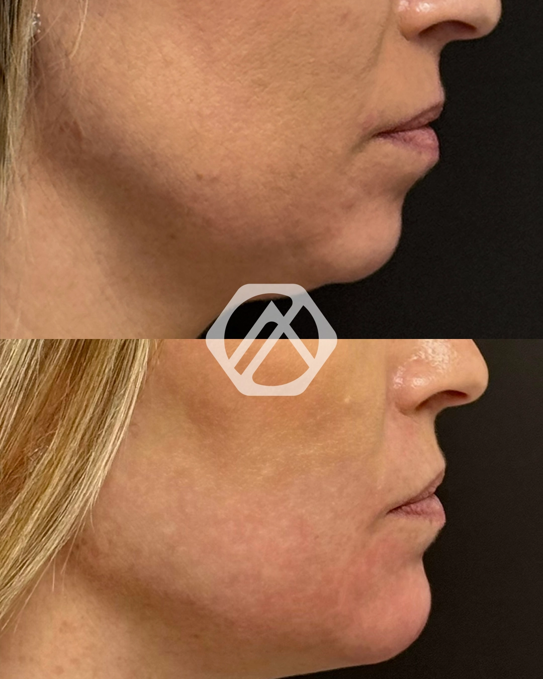 A patient before and after Chin Filler
