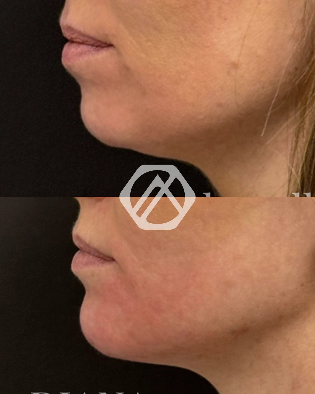A patient before and after Chin Filler