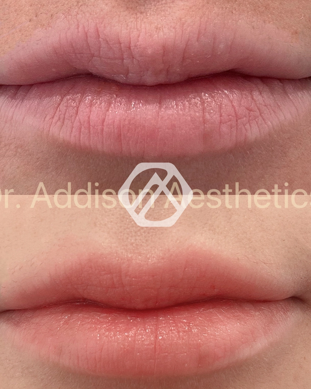 Lip filler