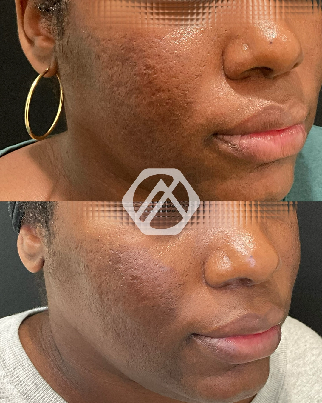 Acne Scar Treatment
